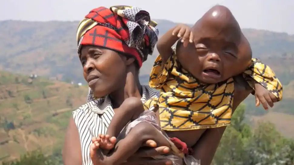 ವಿಚಿತ್ರ ಮಗುವಿಗೆ ಜನ್ಮನೀಡಿದ ಮಹಾತಾಯಿ| ಈ ಮಹಾರೂಪಿ ಮಗುವನ್ನು ನೋಡಿದ್ದೀರಾ…?