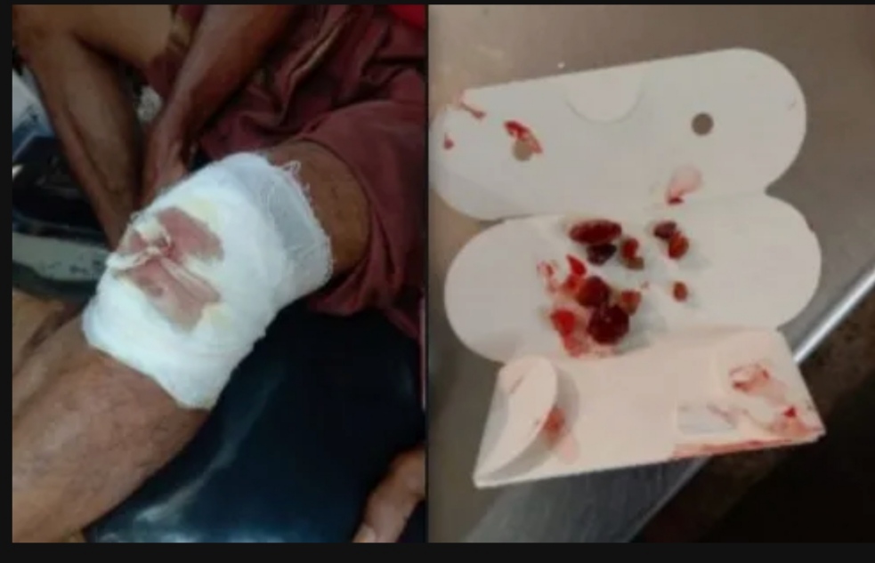 ಕಡಬ ಸರ್ಕಾರಿ ಆಸ್ಪತ್ರೆಯಲ್ಲಿ ಸಿಬ್ಬಂದಿಗಳ ನಿರ್ಲಕ್ಷ್ಯ| ರೋಗಿಯ ಕಾಲೊಳಗಿನ ಕಲ್ಲು ತೆಗೆಯದೇ ಹೊಲಿದ ವೈದ್ಯರು!!?