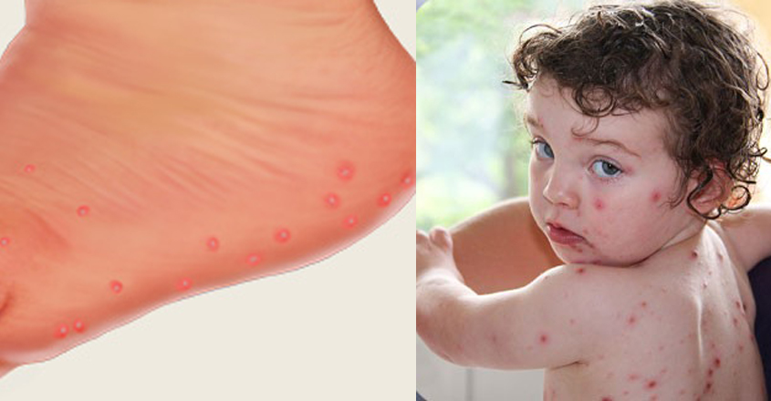 ಕೇರಳದಲ್ಲಿ ಆತಂಕ ಮೂಡಿಸಿದ ಟೊಮೇಟೋ ಜ್ವರ ಎಚ್ಚರ ಎಚ್ಚರ…!