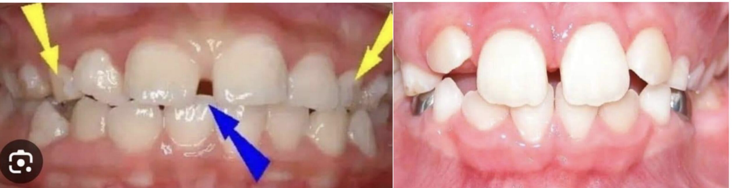 ಏನಿದು ಅಗ್ಲಿ ಡಕ್ಲಿಂಗ್ ಹಂತ?