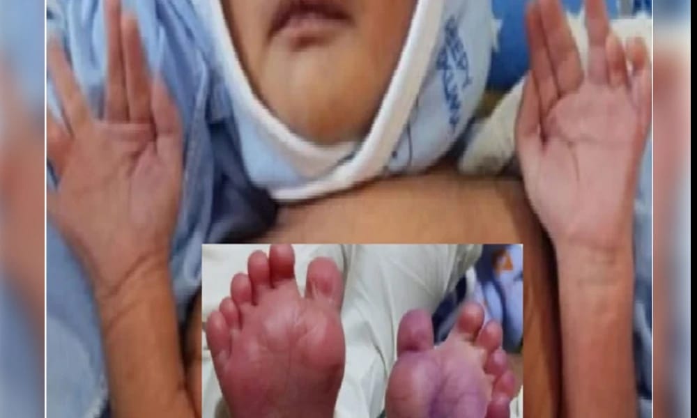 ಬಾಗಲಕೋಟೆ: 25 ಬೆರಳುಗಳಿರುವ ಮಗು ಜನನ..!