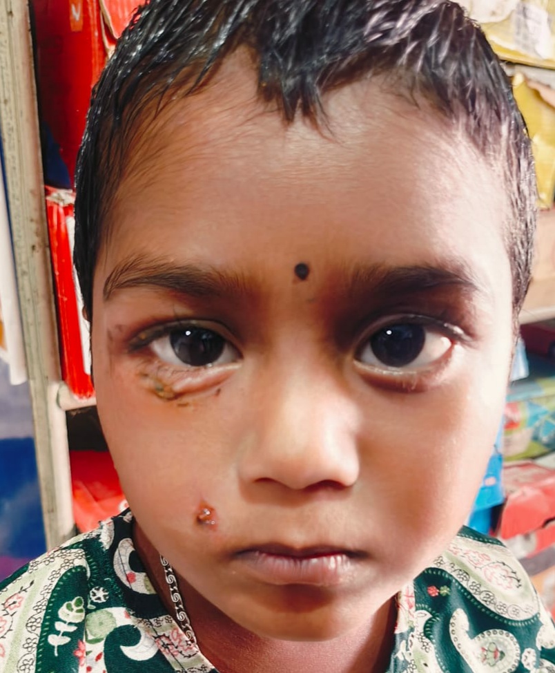 ಬಗ್ಗಸಗೋಡು ಗ್ರಾಮದಲ್ಲಿ ನಾಯಿ ದಾಳಿಯಿಂದ ಮಗುವಿಗೆ ಗಾಯ