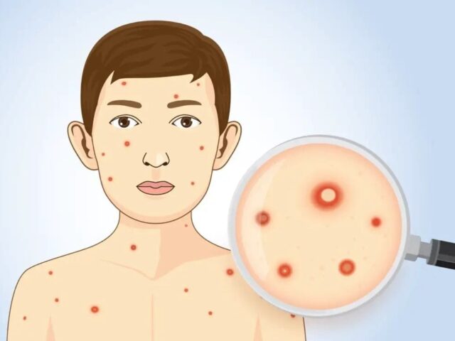 ದ.ಕ‌ ಜಿಲ್ಲೆಯಲ್ಲಿ ಹೆಚ್ಚುತ್ತಿರುವ ಚಿಕನ್‌ ಪಾಕ್ಸ್| ಮುನ್ನೆಚ್ಚರಿಕೆ ವಹಿಸಲು ಸೂಚನೆ